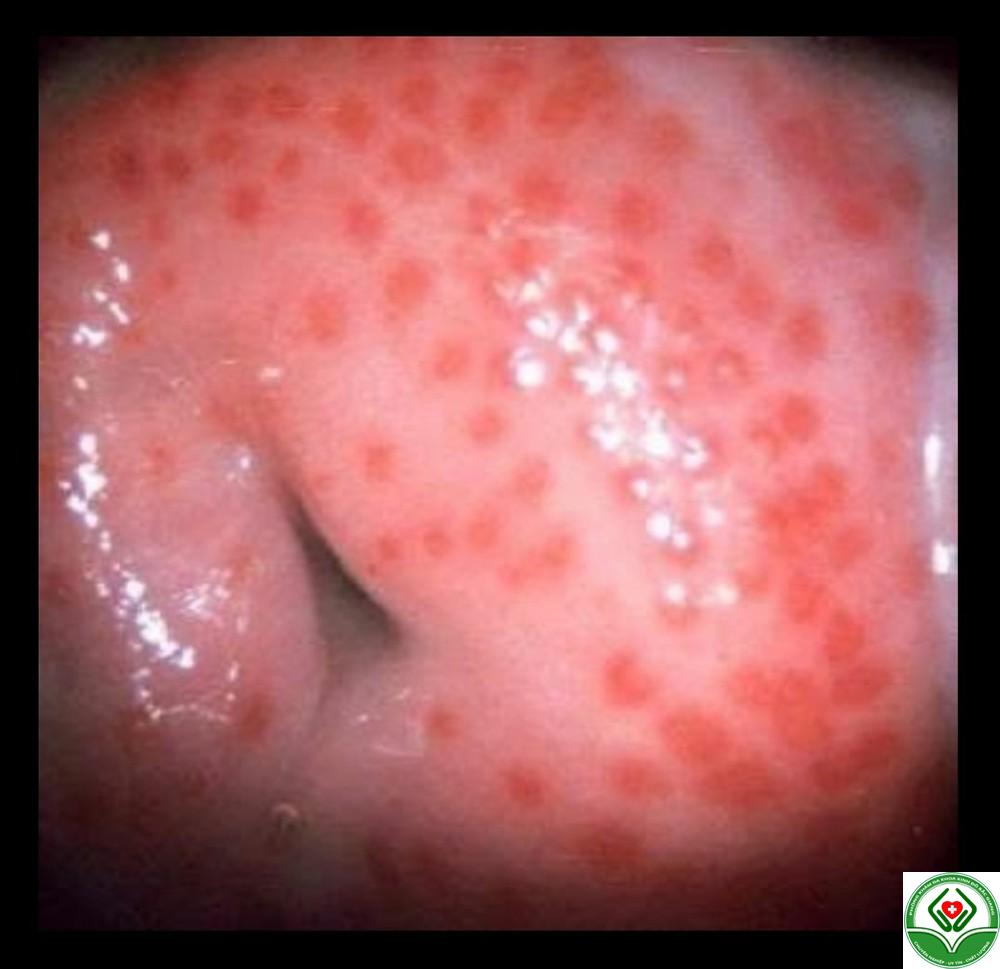 Triệu chứng của Trichomonas ở nam giới