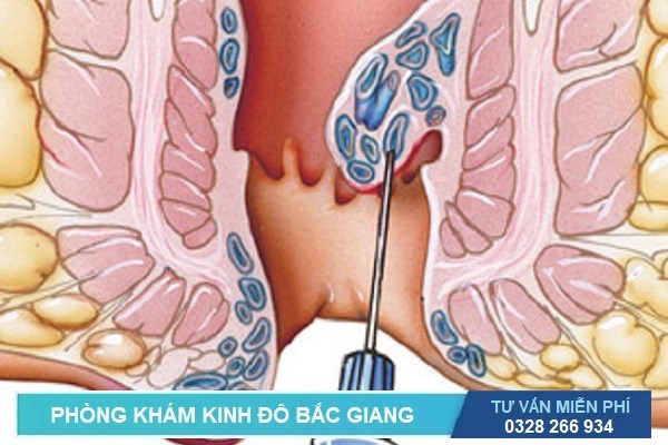 Các phương pháp phẫu thuật trĩ không cần gây mê