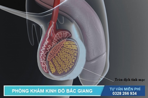 Tràn dịch tinh mạc là 1 trong các bệnh về tinh hoàn