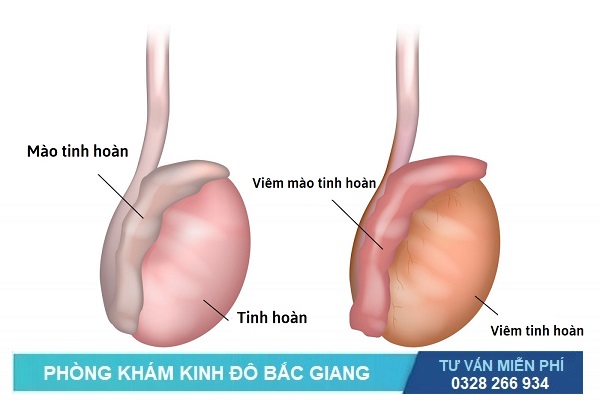 Bệnh viêm tinh hoàn và viêm mào tinh hoàn