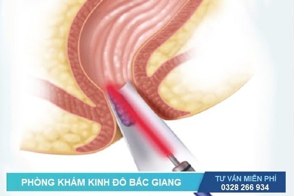 Cắt trĩ bằng laser có hiệu quả không