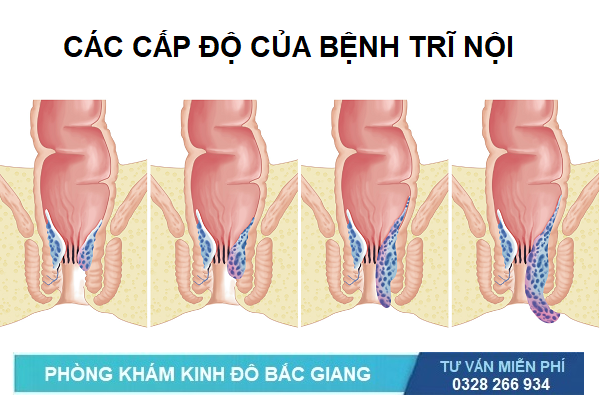 Bệnh trĩ gồm bệnh trĩ giai đoạn đầu (cấp độ 1), 2, 3 và 4