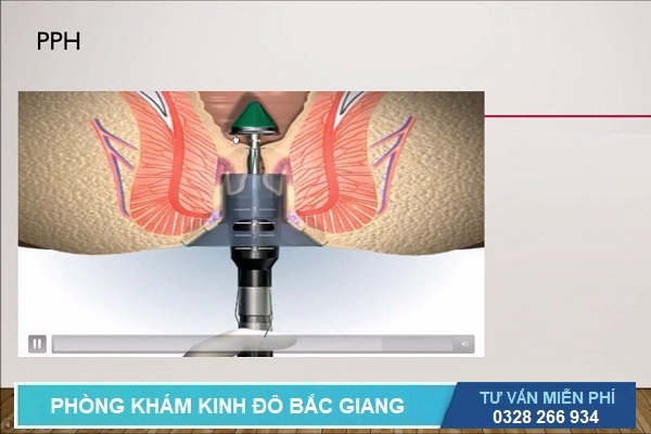 Hình ảnh cắt trĩ bằng phương pháp bấm ghim