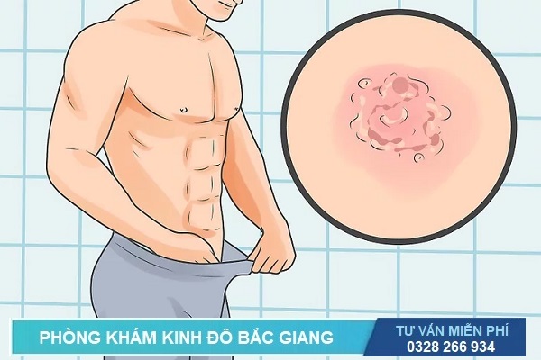 Xét nghiệm là cách duy nhất chuẩn đoán bệnh mụn rộp sinh dục