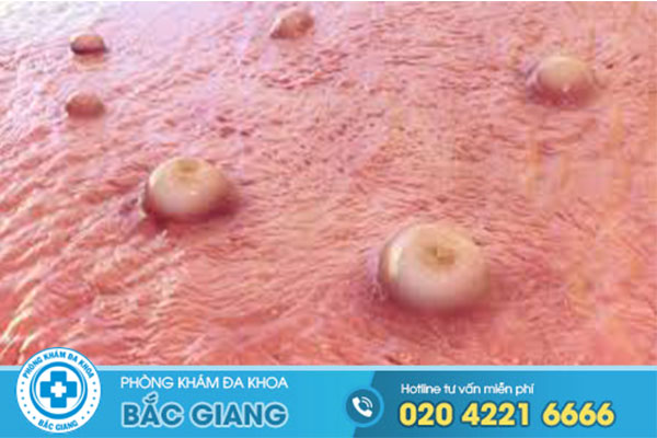 moc-mun-o-chim-do-dau-lam-gi-khi-noi-mun-o-chim