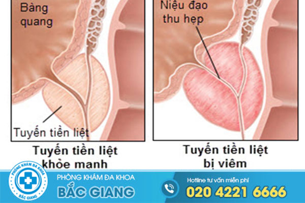 dau-hieu-viem-tuyen-tien-liet-o-nam-gioi-thuong-gap