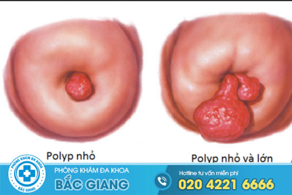 polyp-co-tu-cung-nhung-thong-tin-co-ban-can-nam-ro