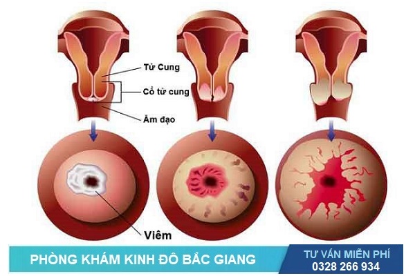 Cách chữa viêm lộ tuyến cổ tử cung tùy thuộc vào mức độ bệnh