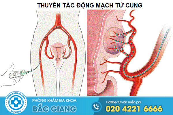 cach-chua-u-xo-tu-cung-bang-phau-thuat-va-tai-nha-tot-nhat-hien-nay