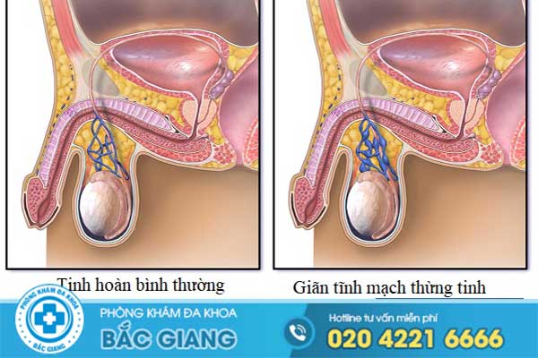 dau-tinh-hoan-ben-phai-o-nam-gioi-lam-the-nao-de-chua-khoi