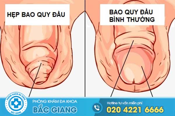 nhung-dau-hieu-bieu-hien-canh-bao-cua-benh-hep-bao-quy-dau-can-di-kham-bac-si-la-gi